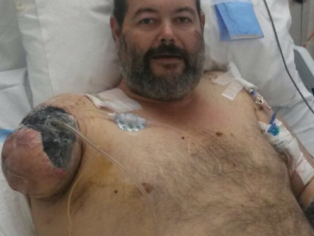 Mr Clark’s arm was so badly injured that he had to have it amputated. Picture: GoFundMe