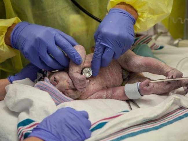 Annie was pink and chubby when she was born. Picture: Abbey Ahern and Sarah Libby Photography