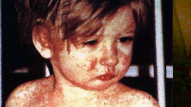 One of the confronting images used in the study. Picture: CDC.