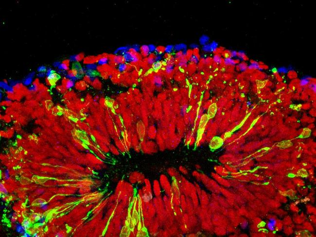 This bundle of human brain cells, known as an organid, reveals the impact of the Zika virus. Picture: Johns Hopkins Medicine