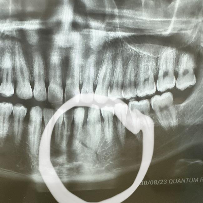 Paulo Aokuso’s broken jaw. Picture: Supplied