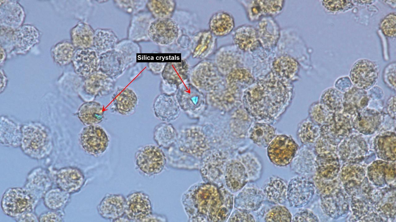 Cells taken from the lungs of a patient with silicosis (notice the speck of silica dust shining brightly).