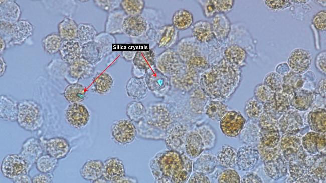 Cells taken from the lungs of a patient with silicosis (notice the speck of silica dust shining brightly).