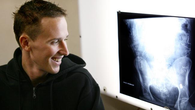 Dutch backpacker Paul de Waard looks at an x-ray showing a bullet lodged in his body after coming to the aid of Kaera Douglas.