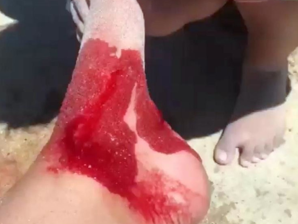 The schoolgirl needed stitches in her foot after being bitten by a shark at a beach in North Cottesloe. Picture: Seven News