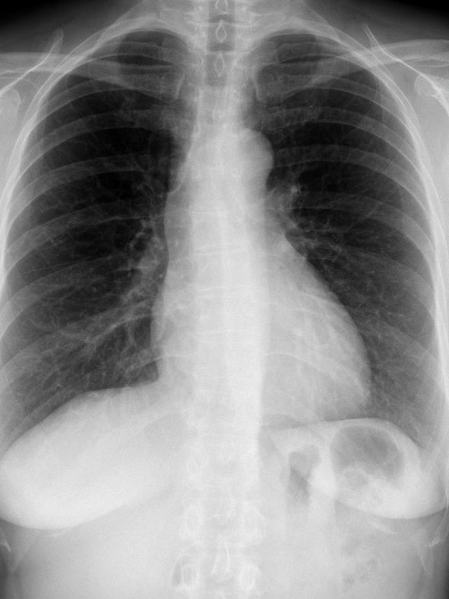 A X-ray of someone with healthy lungs. Picture: Henry Knipe,<a href="https://radiopaedia.org/cases/normal-chest-x-ray-1" title="radiopaedia.org"> Radiopaedia.org, rID: 31525</a>