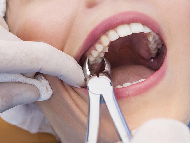 Young woman having tooth removed. Close up picture of a woman mouth with a dentist hand holding extraction forceps