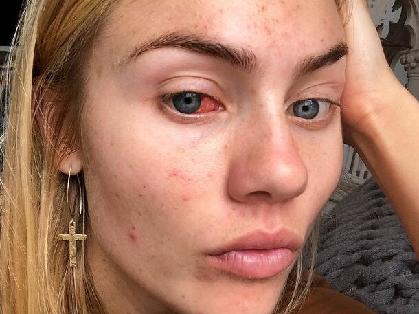 Elyse Knowles was hailed by fans for sharing her struggle with acne. Picture: Instagram