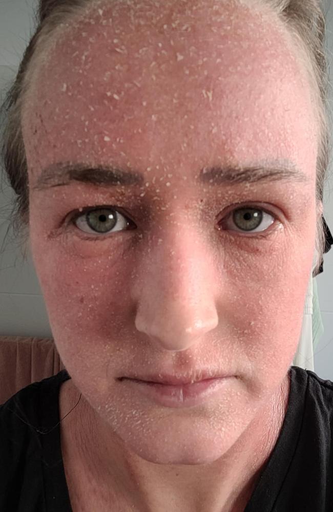Kate Hodgkison battled eczema. Picture: Supplied