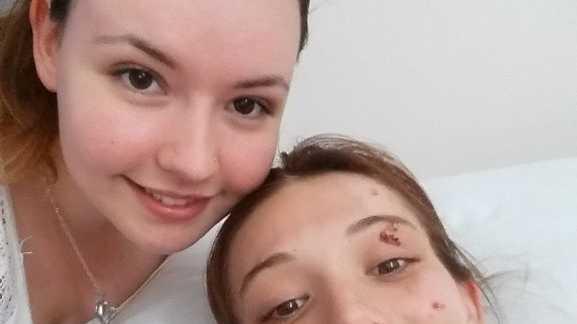 Kintara Andrews is now recovering 12 months after beening hit by a car crossing the Bruce Highway, Gympie. Pictured with her sister (left) Emma Bryce. CONTRIBUTED. Picture: Contributed