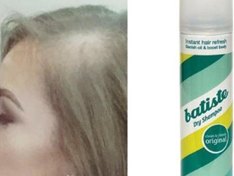 Woman says dry shampoo made her bald