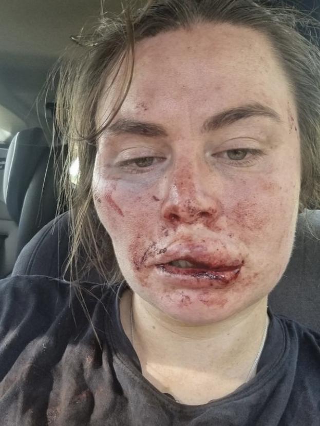 She was left with facial injuries.