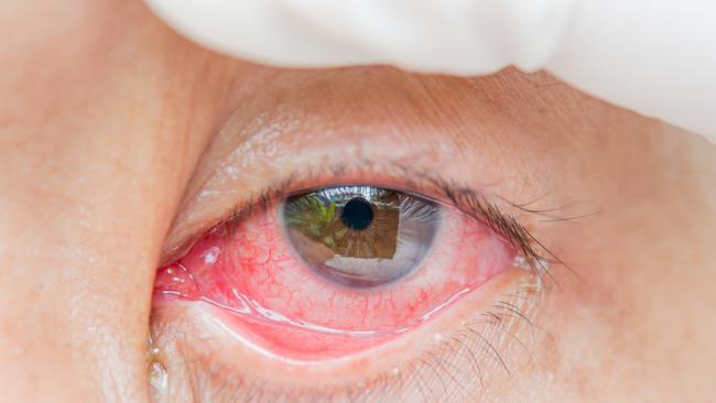 red bloodshot eye IStock image