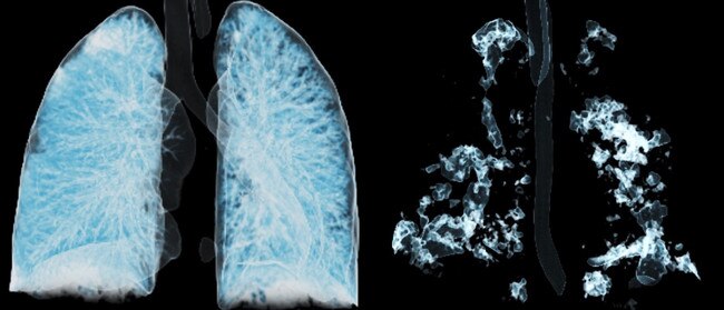 A CT scan of normal lungs (left), compared to the lungs of a person who died of Covid (right). Picture: Supplied