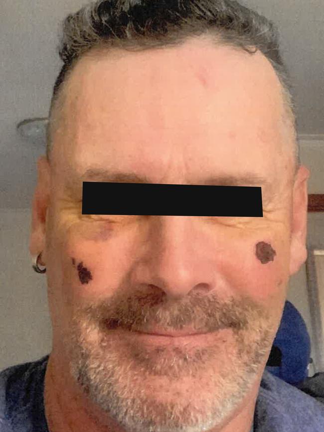 The victim of Andrew Martini’s assault during his recovery. Pictures: supplied