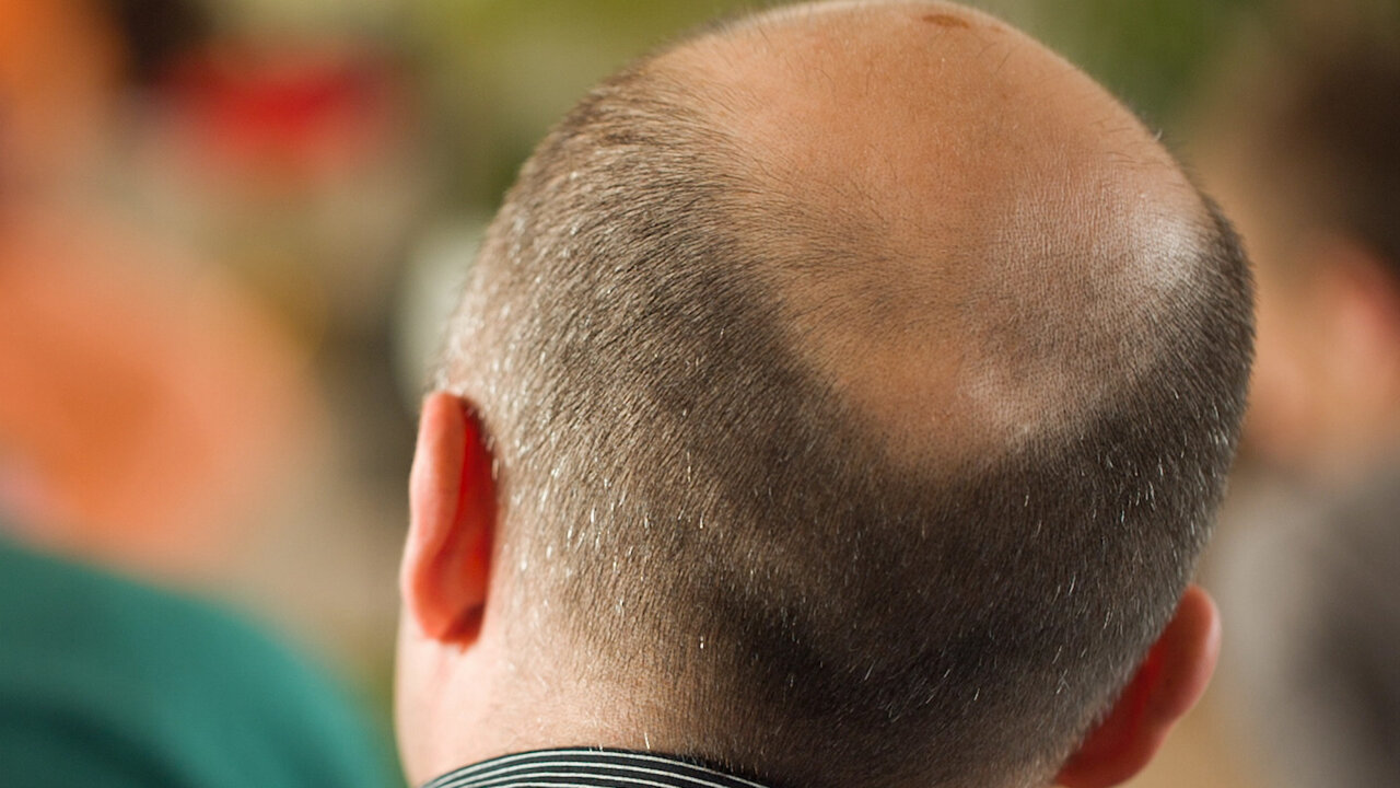 Why Do Men Go Bald?