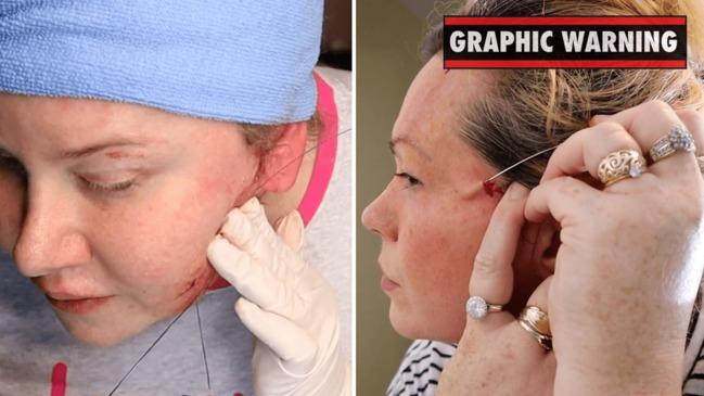 Aussie Youtubers perform “dangerous” tutorials, says cosmetic surgeon