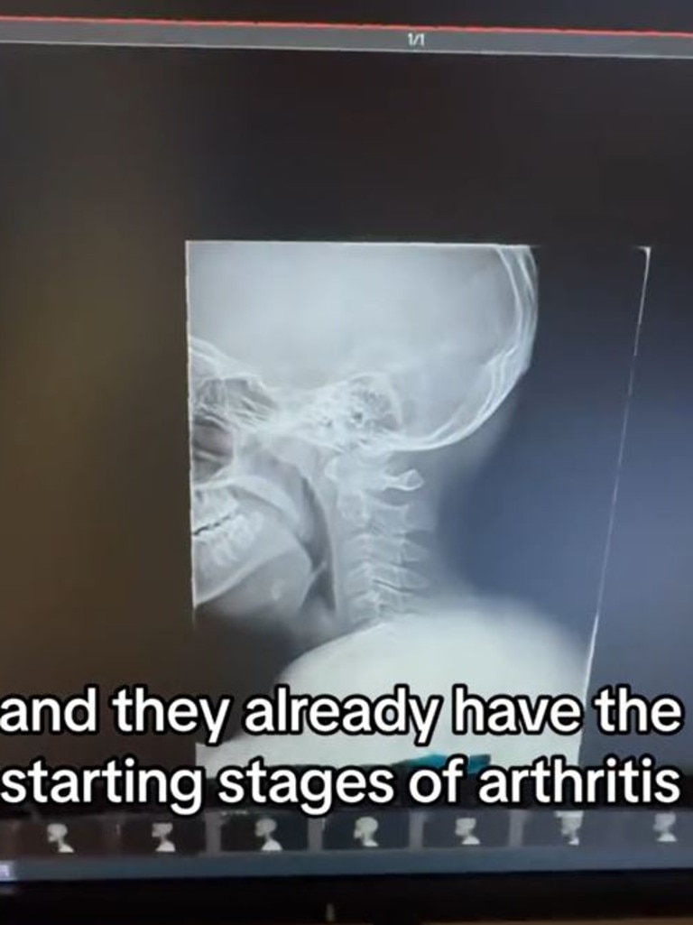 An X-ray of a person born in 2011 shows the ‘starting stages’ of arthritis. Picture: @desmoineschiro/TikTok
