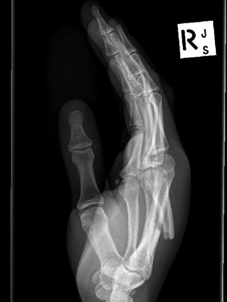 The shocking X-rays reveal the extent of Boot’s injury.