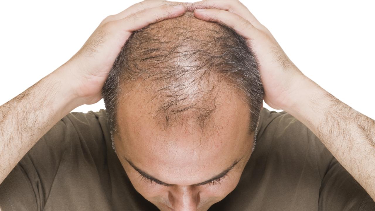 Hair loss in both men and women has been revealed as a long Covid symptom.