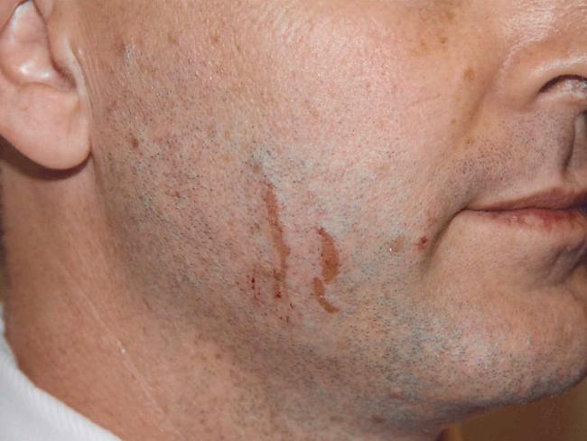 Court exhibit from the Gerard Baden-Clay murder trial. Images of scratches and cuts on Gerard Baden-Clay's body.