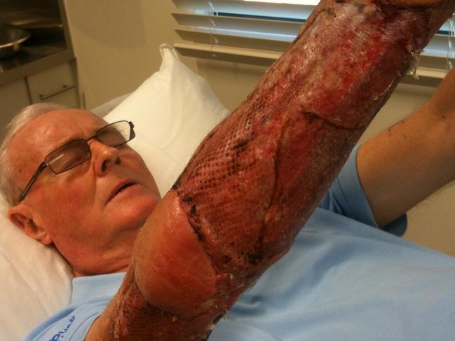 Former Olympian Neil Hewitt shows the devastating impact of the Buruli Ulcer.