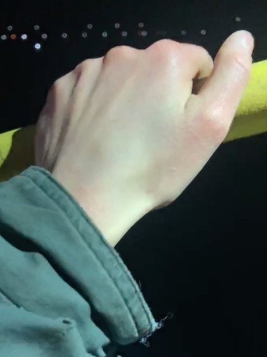 Ms Ilbery’s hand super glued to the railing. Picture: Supplied