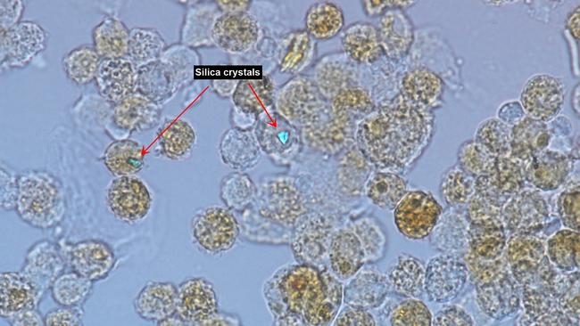 Cells taken from the lungs of a patient with silicosis, notice the speck of silica dust shining brightly. Picture: Supplied