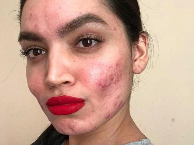 The beauty blogger, who has 124,000 followers, openly posts pics of her skin troubles. Picture: Instagram