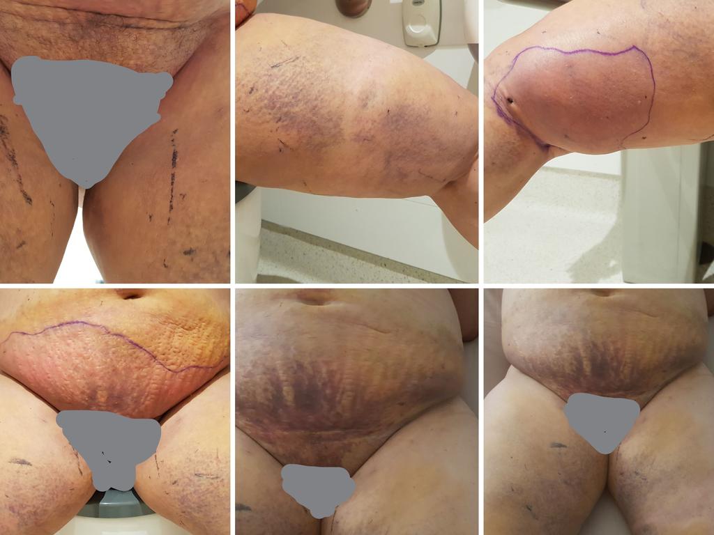Mum left for dead after botched tummy tuck - NZ Herald