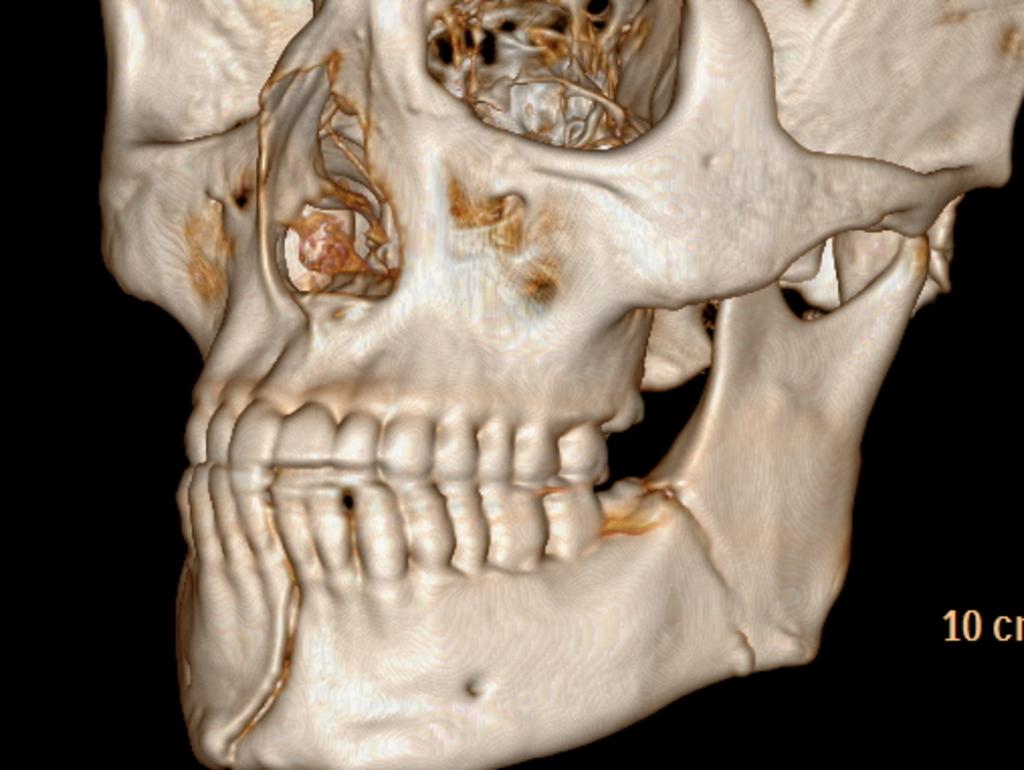 Mr Chance’s jaw was left broken.