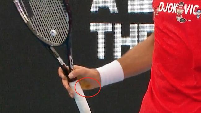 Novak Djokovic hands with blisters.