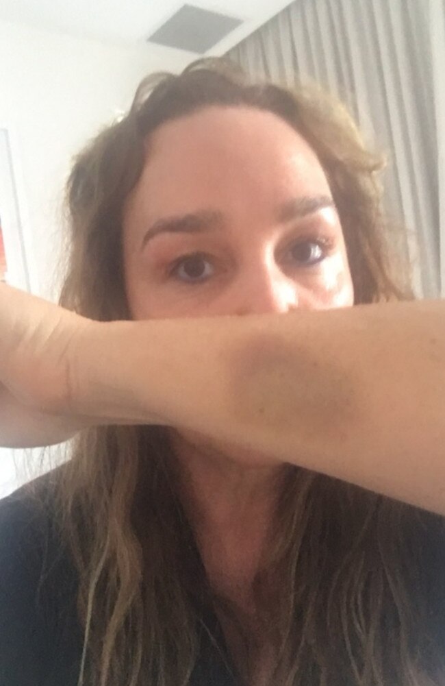 “The real vulnerable are the decent citizens of St Kilda,” Langbroek wrote in the tweet showing her bruises. Picture: Twitter/Kate Langbroek