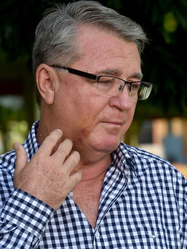 Mundingburra MP Les Walker fronts the media at Soroptimist Park with a large bruise on his face. Picture: Evan Morgan