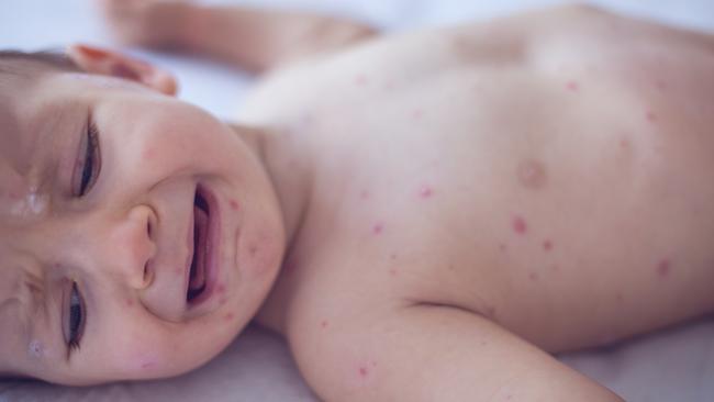 Crying baby girl with measles  Picture: istock