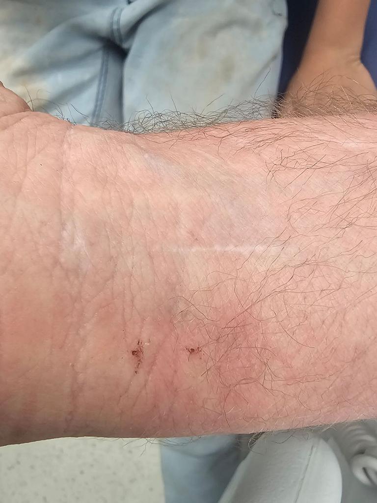 Snake Catcher's Harrowing Story Of Surviving A Brown Snake Bite