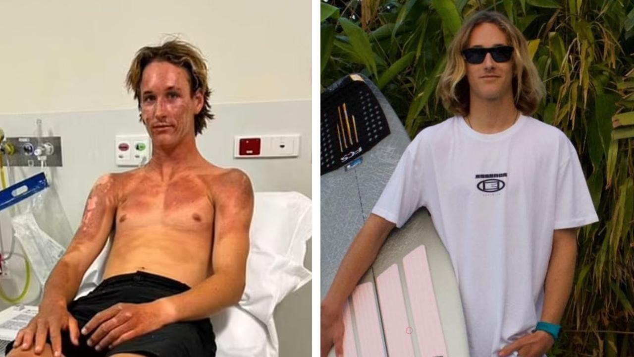 Teen surfer’s horror injury on remote island