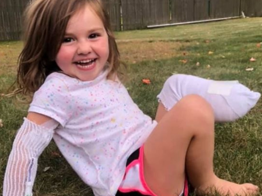 Mums Warning After Daughter Loses Leg In Horrific Lawnmower Accident Au — Australia 