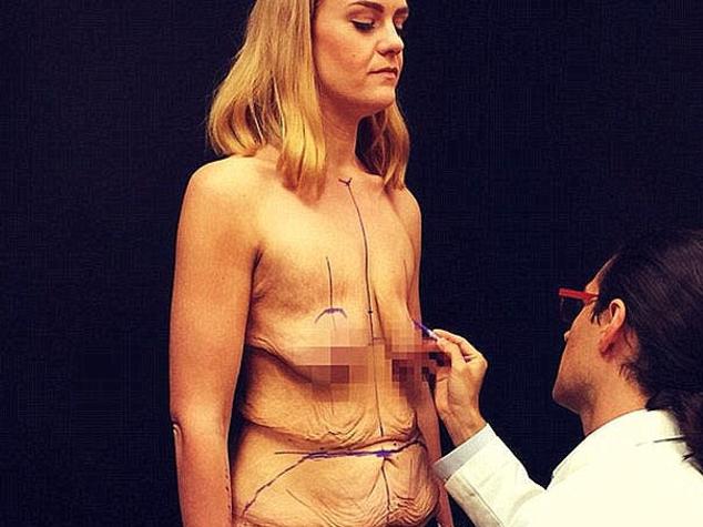 Weight loss star has excess skin removed
