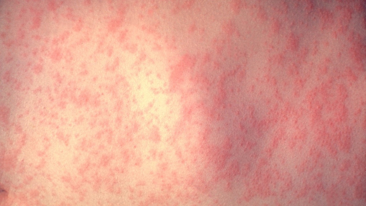 Measles diagnoses spark fears the virus has evolved to overcome vaccines