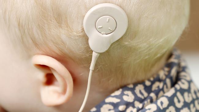 Baby with a cochlear implant. (Image/Josh Woning)