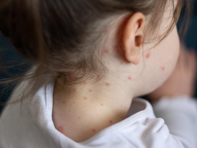 Close-up of a girl with chickenpox measles on the body