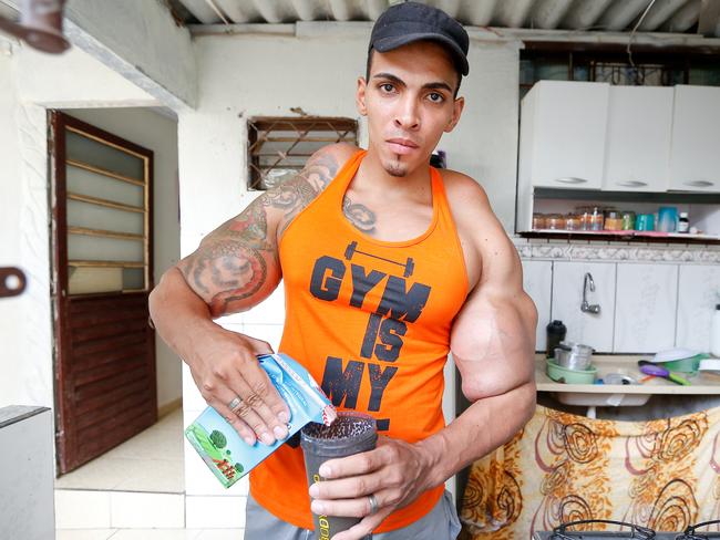 Romario Dos Santos Alves Injecting Oil Into Muscles Almost Cost Him His Arm Daily Telegraph