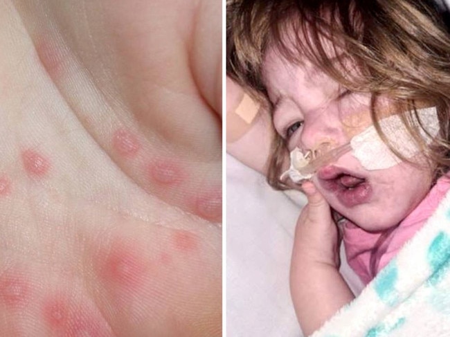 The usually harmless hand, foot and mouth disease that spreads quickly, typically among daycare aged children has left one Queensland toddler fighting for life in hospital.