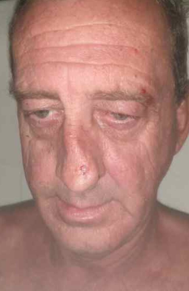 Dave said he was left battered and bruised after the alleged incident. Picture: Ben Fordham 2GB