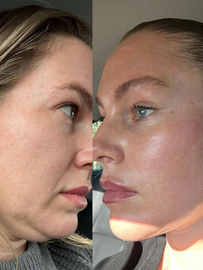 The social media influencer’s side profile before and after her facelift.