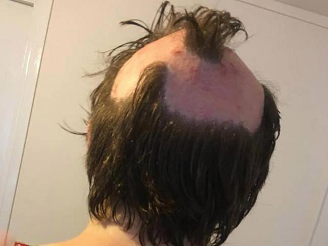 Unicorn hair: Mother's home dye job left her scarred and burnt |   — Australia's leading news site