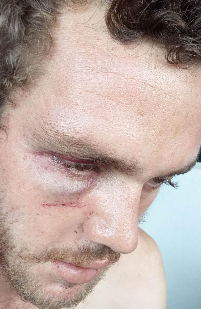 Millner resident Jayden Kearney has suffered an eye socket fracture, jaw fracture, chipped teeth and split lips as a result of a road rage attack at Coolalinga. Picture: Supplied