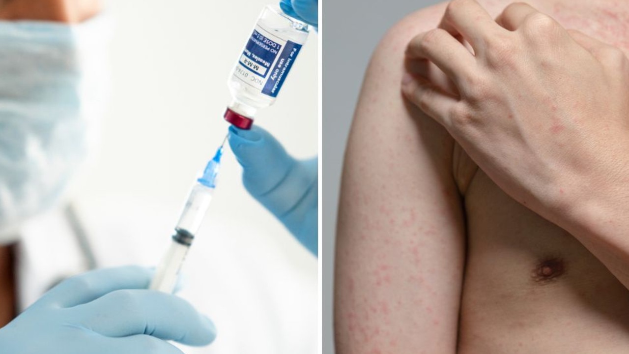 Public health alert: Potential measles exposure in Cairns