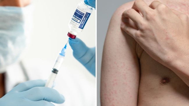 Public health alert: Potential measles exposure in Cairns. Picture: iStock.